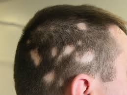 best alopecia treatment clinic in bhubaneswar close to aiims hospital